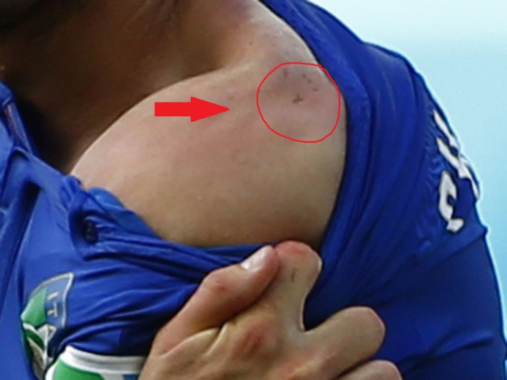 Giorgio Chiellini's shoulder