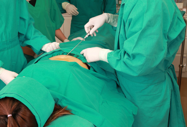 Liposuction Procedure