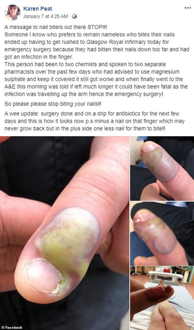 Nail infection