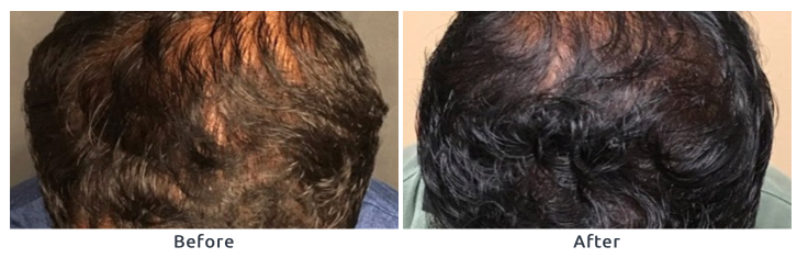 Hair restoration