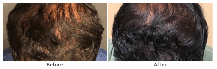 Hair restoration 