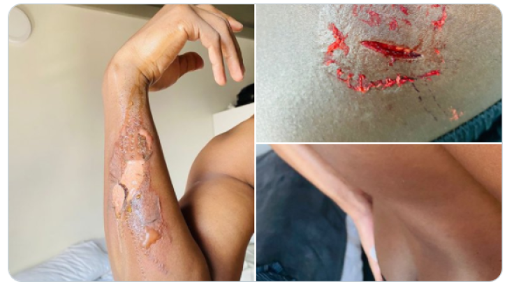South African man shows off injuries after he was poured with boiling water and then stabbed by his girlfriend.