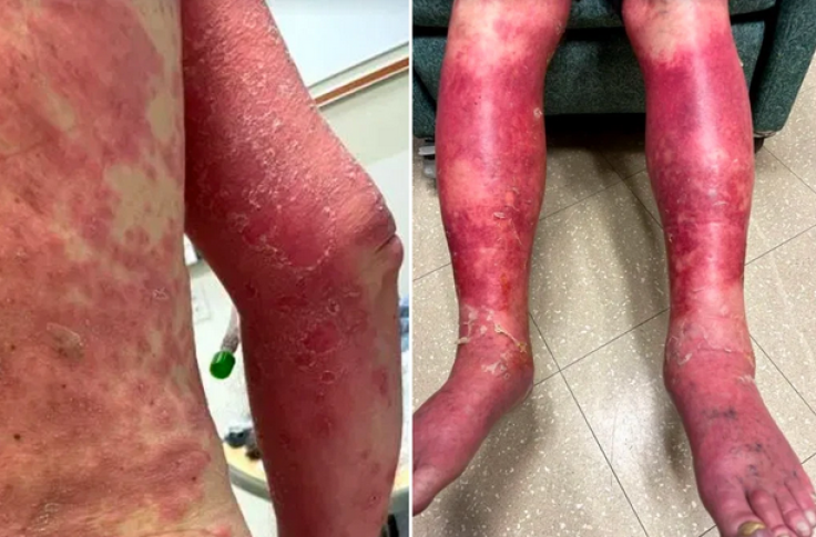 skin peeling reaction from COVID-19 vaccine