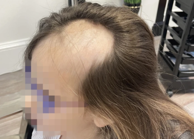 Five-year-old left partially bald after freak accident