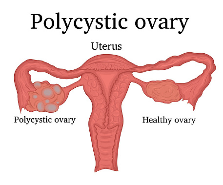 PCOS/PCOD