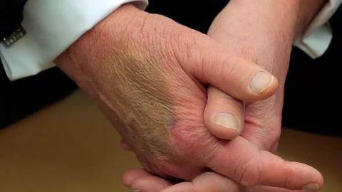 'Massive' Bruise on Trump's Hand Spurs Flood of Theories About His Health