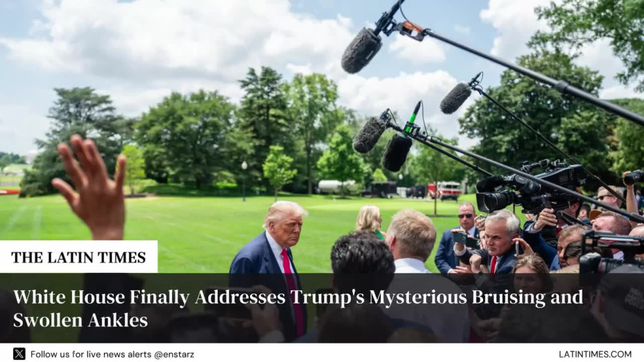 White House Finally Addresses Trump's Mysterious Bruising and Swollen Ankles