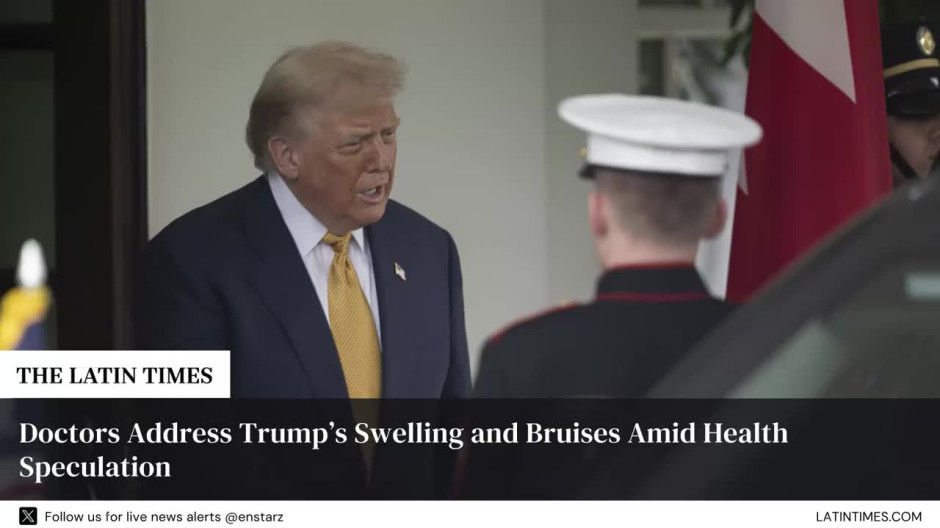 Doctors Address Trump’s Swelling and Bruises Amid Health Speculation